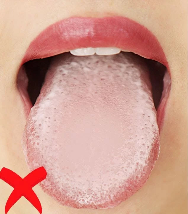 Comparison of a tongue with and without plaque, indicated by red 'X' and green check mark.