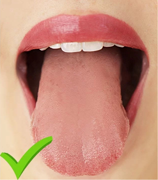 Comparison of a tongue with and without plaque, indicated by a red cross and green check mark.